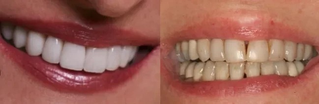 dental veneers before and after photos