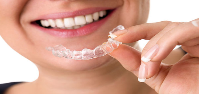 كم مدة مثبت الأسنان المتحرك بعد التقويم؟