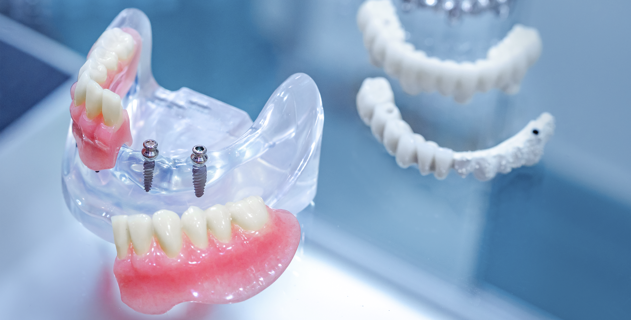 كيف يتم تثبيت الاسنان المتحركة؟