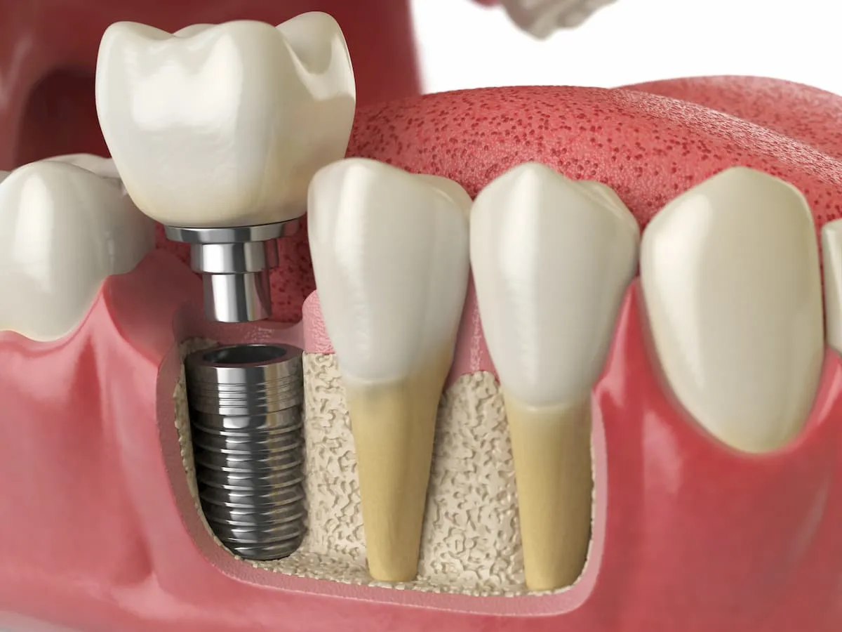 ما الفرق بين تكلفة زراعة الاسنان الفورية والتقليدية؟