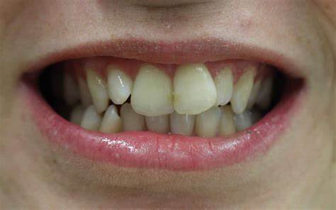 What are crooked teeth?