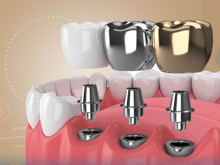 ما هي العوامل التي تتحكم في تكلفة زراعة الأسنان؟