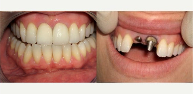 هل زراعة الاسنان آمنة؟