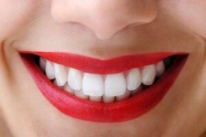 تفاصيل حول ابتسامة هوليود تكلفة وأهم فوائد وأضرار التجميل!