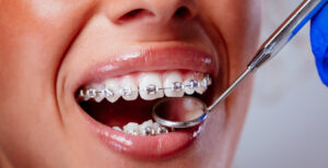 اكتشف أحدث التطورات في جهاز تقويم الاسنان وأنواع التقويم المختلفة!