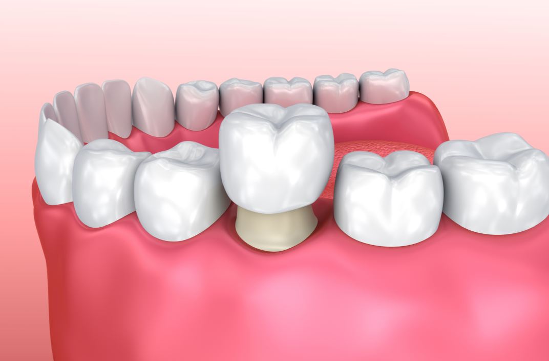 أضرار طربوش الأسنان