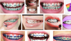 ما هي ألوان تقويم الأسنان للبنات؟ وتعرف على أفضل مركز لتركيبها في القاهرة