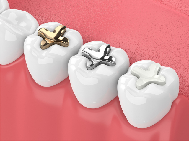 أنواع حشوة الأسنان الدائمة
