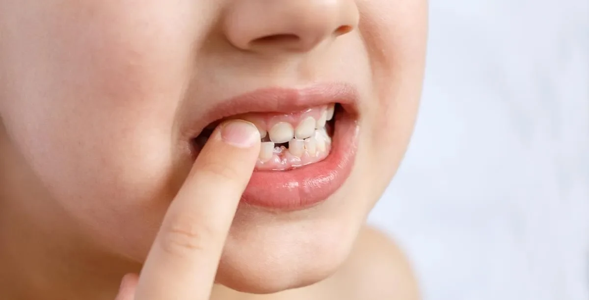 كيفية علاج الفراغات بين الاسنان
