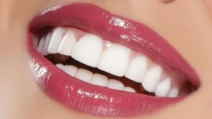 ابتسامة هوليود بدون برد الاسنان وسعرها في المركز الطبي لرعاية الأسنان