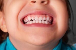 اكتشف سبب تآكل اسنان الاطفال وأفضل علاج مميز بالاعشاب لها !