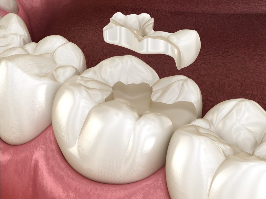 ما هي الحشوات التجميلية لسد الفراغات بين الأسنان؟