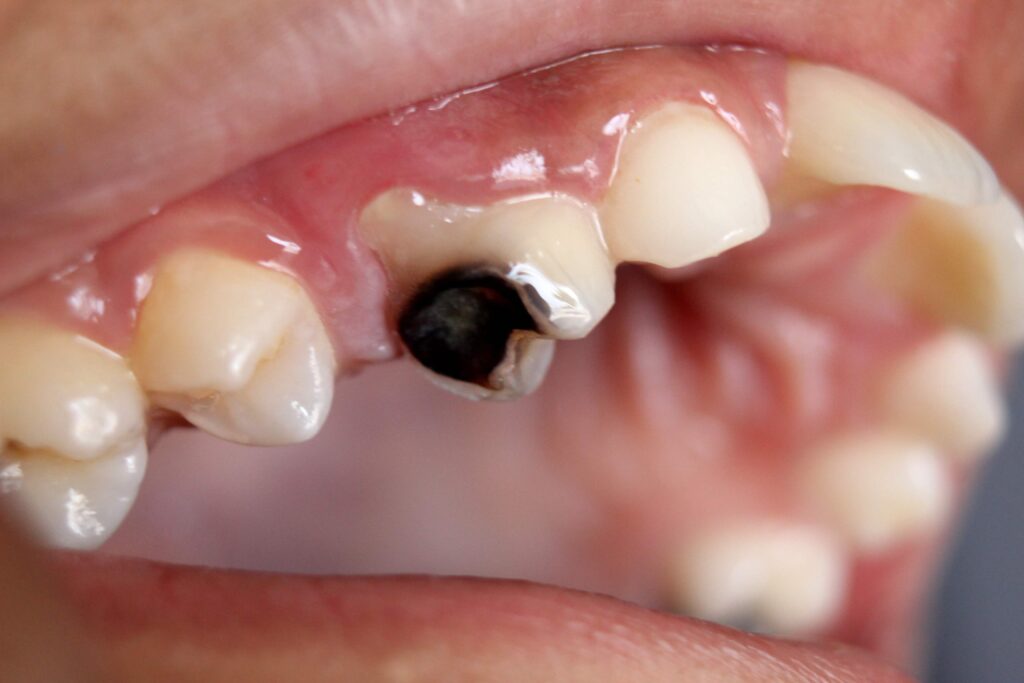اعراض تسوس الاسنان