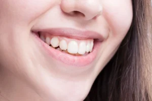 الاسنان البارزة للامام وما هي مدة التقويم اللازمة لذلك؟