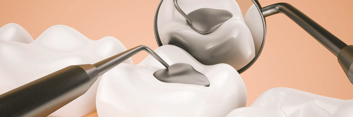 ما هي مميزات الحشوات التجميلية لسد الفراغات بين الأسنان؟