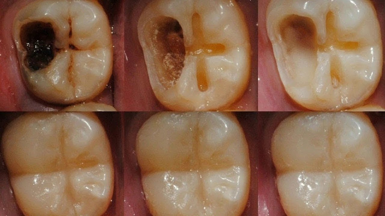 انواع تسوس الاسنان