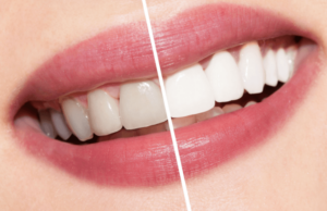 ما الفرق بين الفينير وابتسامة هوليود؟ وهل هوليود سمايل مضرة للأسنان؟