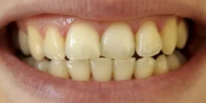 ما أسباب تصبغات الاسنان الصفراء؟ وتعرف على افضل مركز لعلاج و تجميل الاسنان