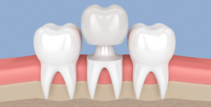 ما هو تاج الاسنان؟ وتعرف على أفضل مركز لعلاج وتجميل الأسنان