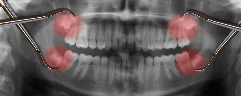جراحة الاسنان ضرس العقل