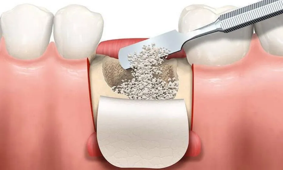استفد من معرفتك بزراعة العظم للاسنان واطلع على المخاطر الرئيسية لهذه العملية!