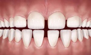 كيفية سد فراغات الاسنان بدون تقويم وتكلفة علاجها في المركز الطبي لرعاية الأسنان