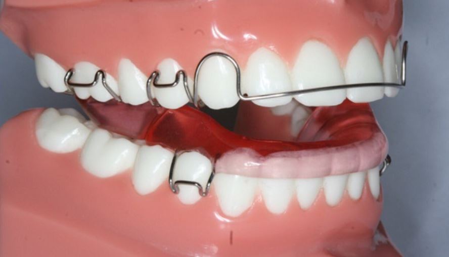 ما سعر مثبت الأسنان بعد التقويم والأنواع المتوفرة منه؟