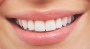 ما الفرق بين تبييض الاسنان وابتسامة هوليود؟ وتفاصيل أكثر عن التكلفة في مصر