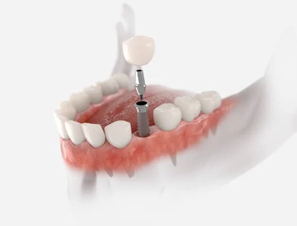 طريقة زراعة الأسنان الفورية