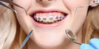 ما هي عوامل تباين تكلفة تقويم الأسنان؟