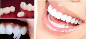مراحل تركيب عدسات الاسنان