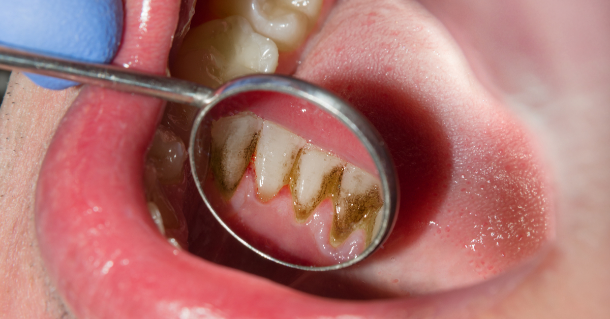 مضاعفات تسوس الاسنان