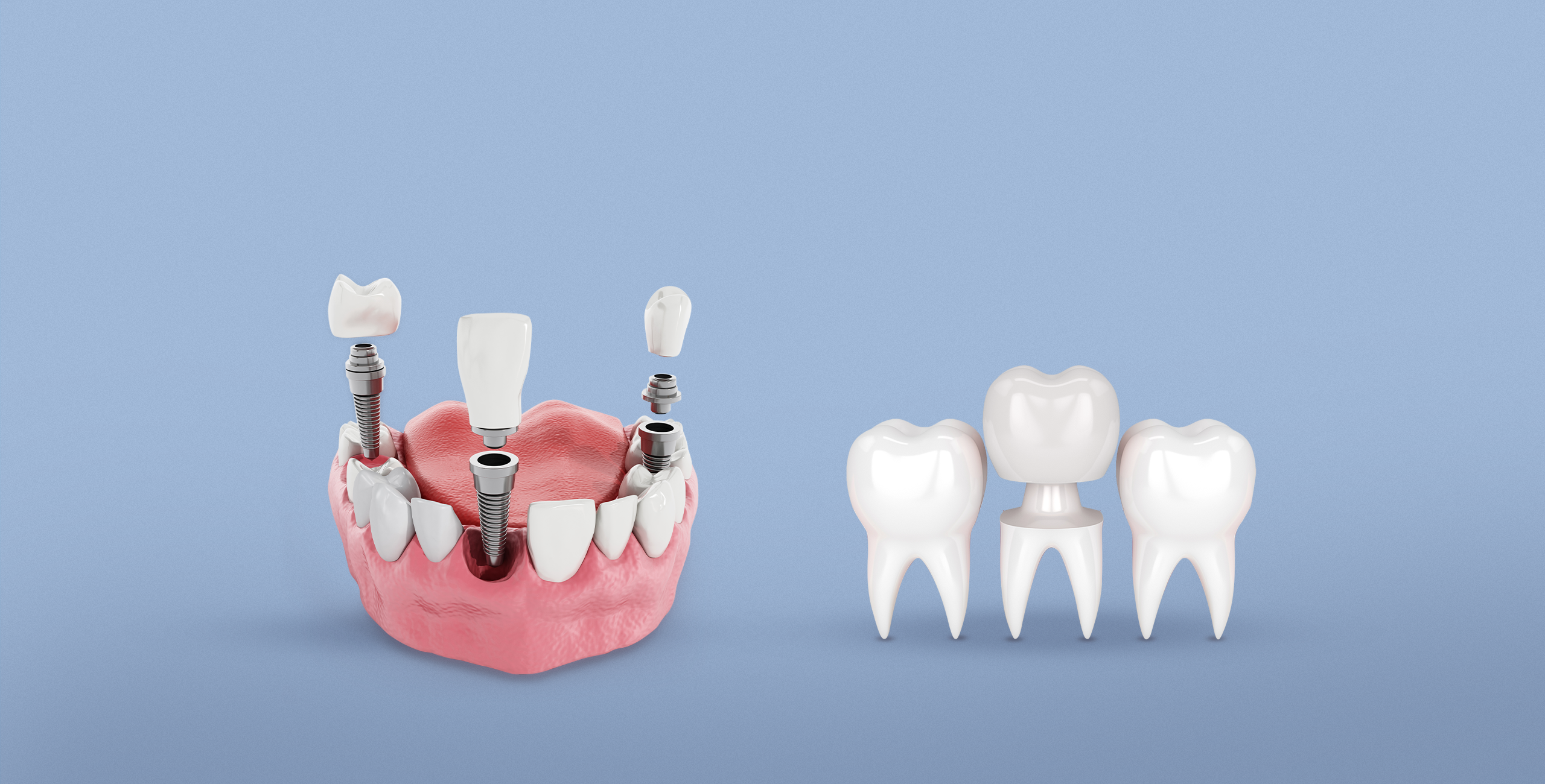 What are the advantages of dental implants?