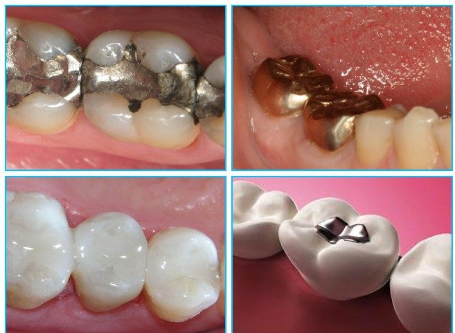 انواع الحشوات المستخدمة للأسنان