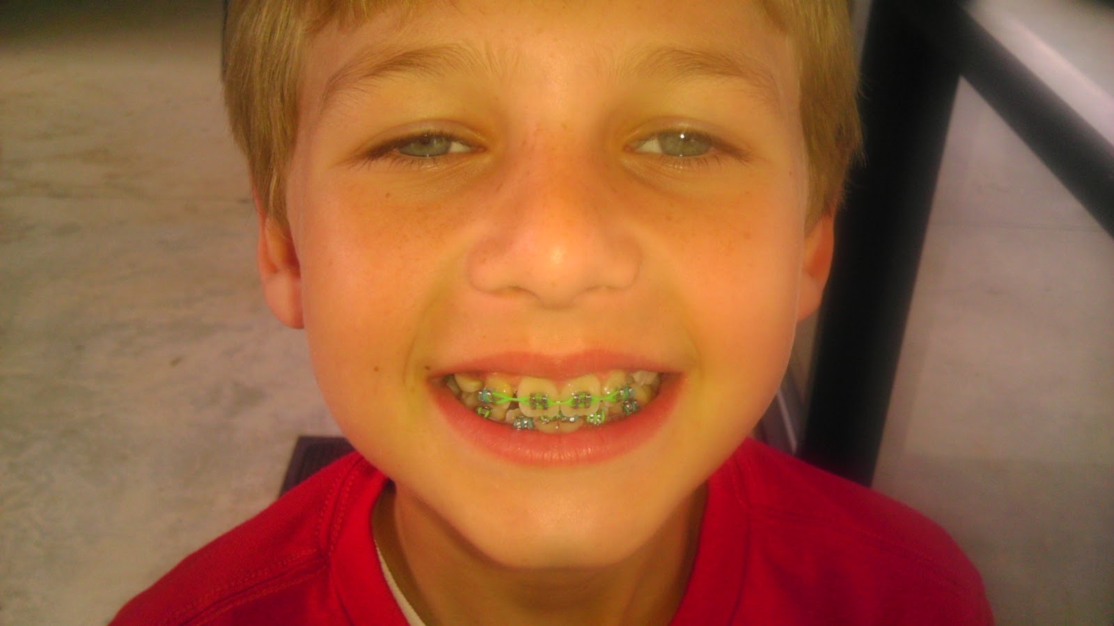 How can I straighten my teeth at home?