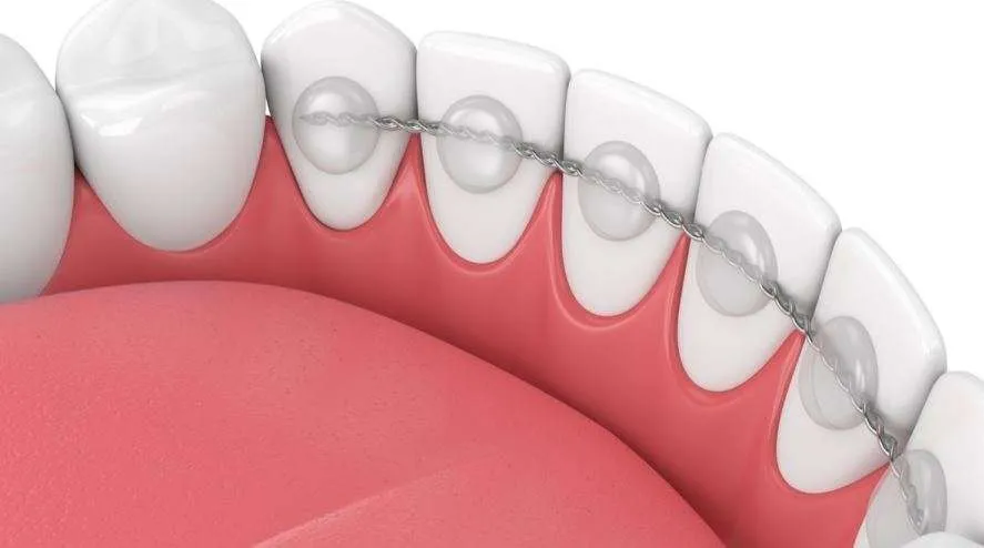 ما أنواع مثبت الأسنان بعد التقويم؟