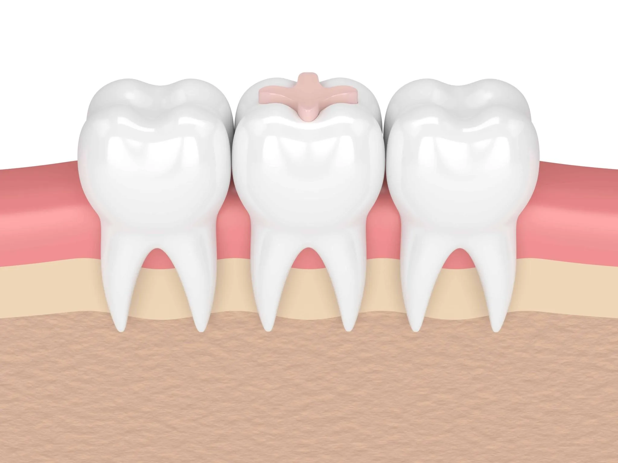 ما هي العوامل المؤثرة على سعر الحشوة التجميلية للأسنان؟
