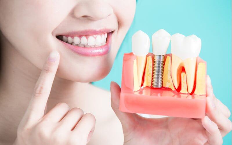 مميزات عمليات زراعة الأسنان