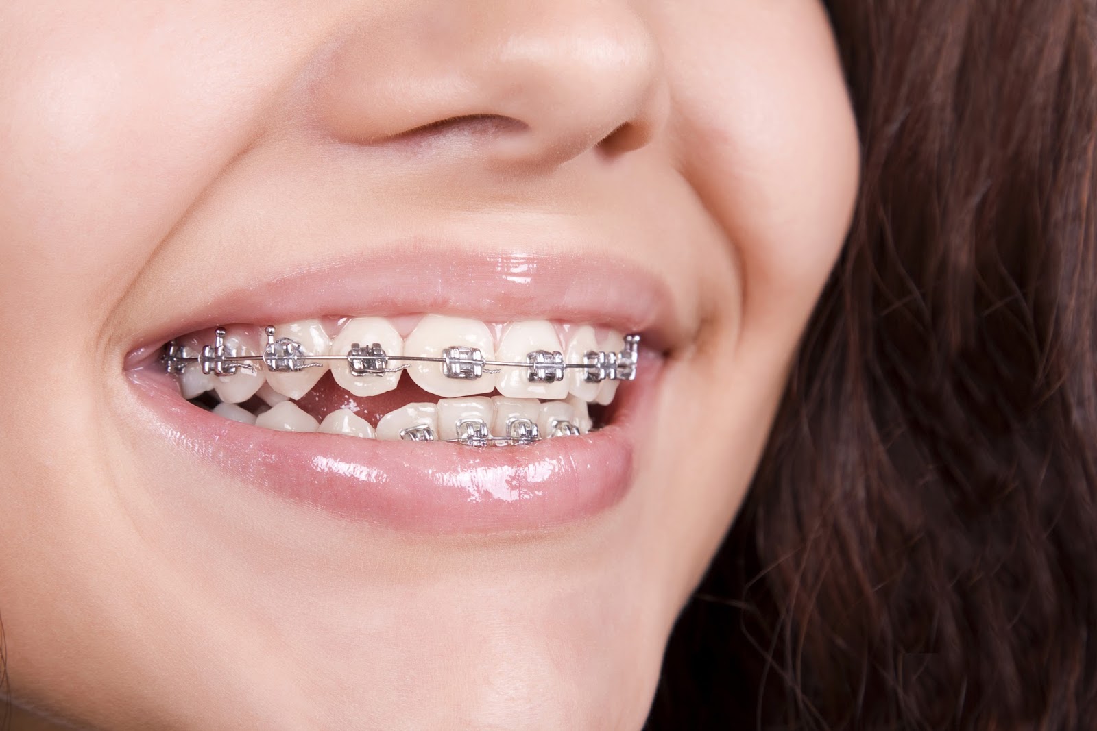 هل يمكن تسريع نتائج تقويم الأسنان في علاج تفرق الأسنان ؟
