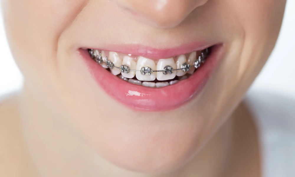 كيف يتم إغلاق الفراغات بين الأسنان أثناء التقويم؟