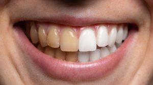 احصل على عرض ابتسامة هوليود وتعرف على أفضل مركز لعلاج وتجميل الأسنان