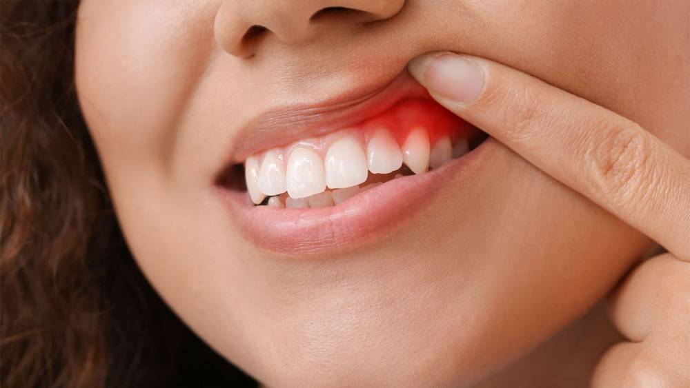 أسباب التهاب اللثة بعد زراعة الأسنان