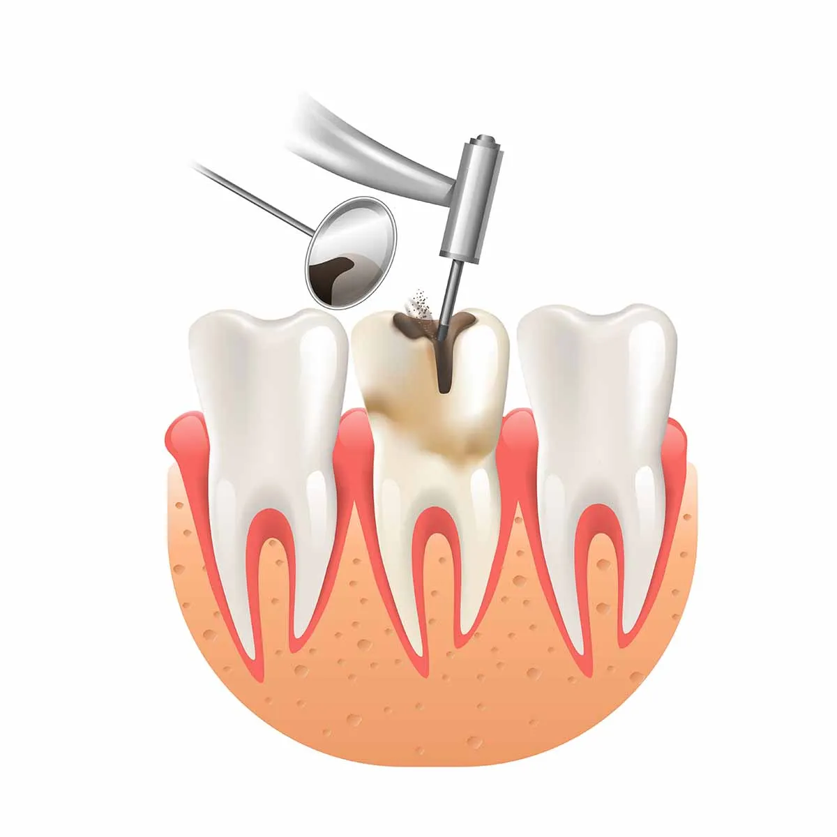 أنواع الحشوات المختلفة لعلاج تسوس الأسنان