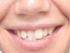مشكلة اعوجاج الاسنان عند الكبار وكيفية الوقاية منها