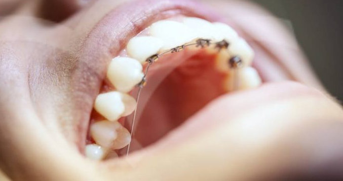كم مدة علاج التقويم الداخلي للأسنان؟