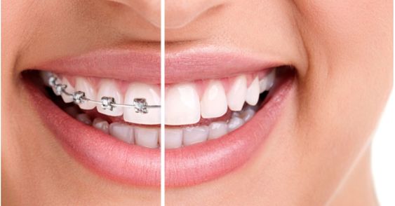 هل يمكنك علاج الاسنان المتضررة سابقا خلال فترة التقويم؟