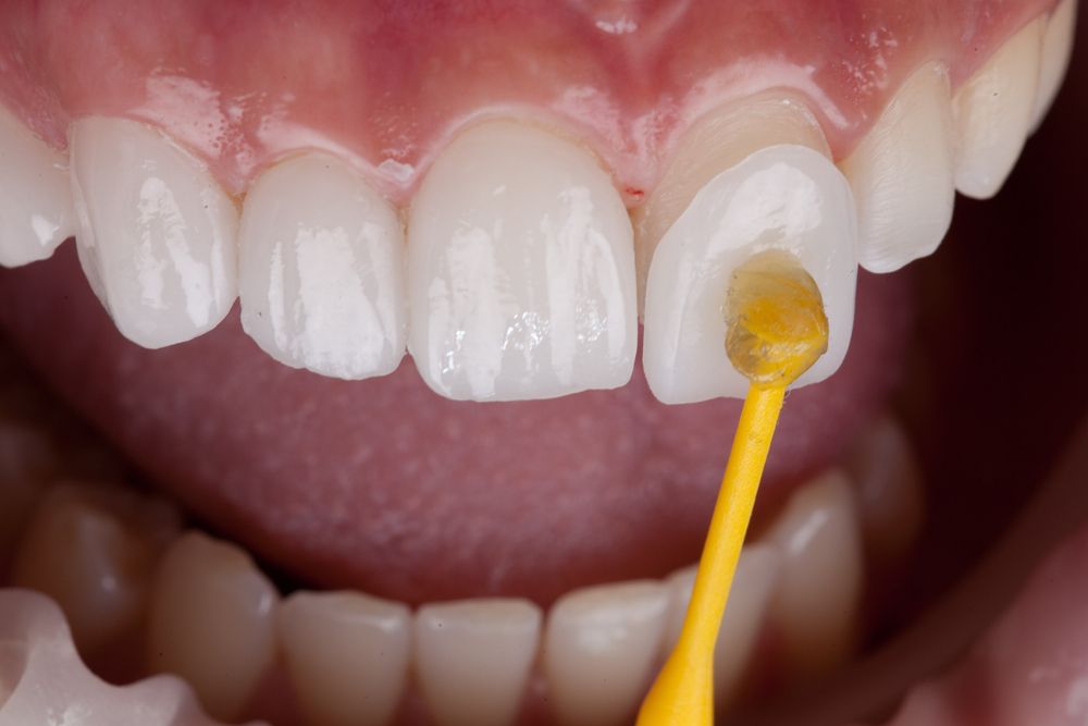 كم يدوم عدسات الأسنان ؟
