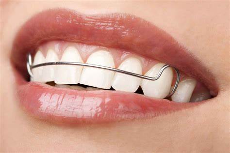 طرق تعديل الأسنان بدون تقويم