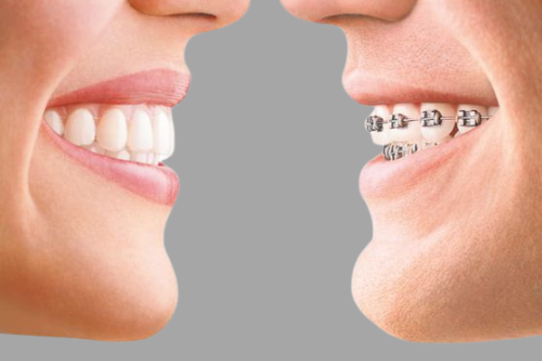 كم نسبة نجاح تركيب تقويم الاسنان؟