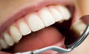 تجميل الاسنان بدون تقويم ومن هُم الأشخاص المُرشحون لتعديل الأسنان؟